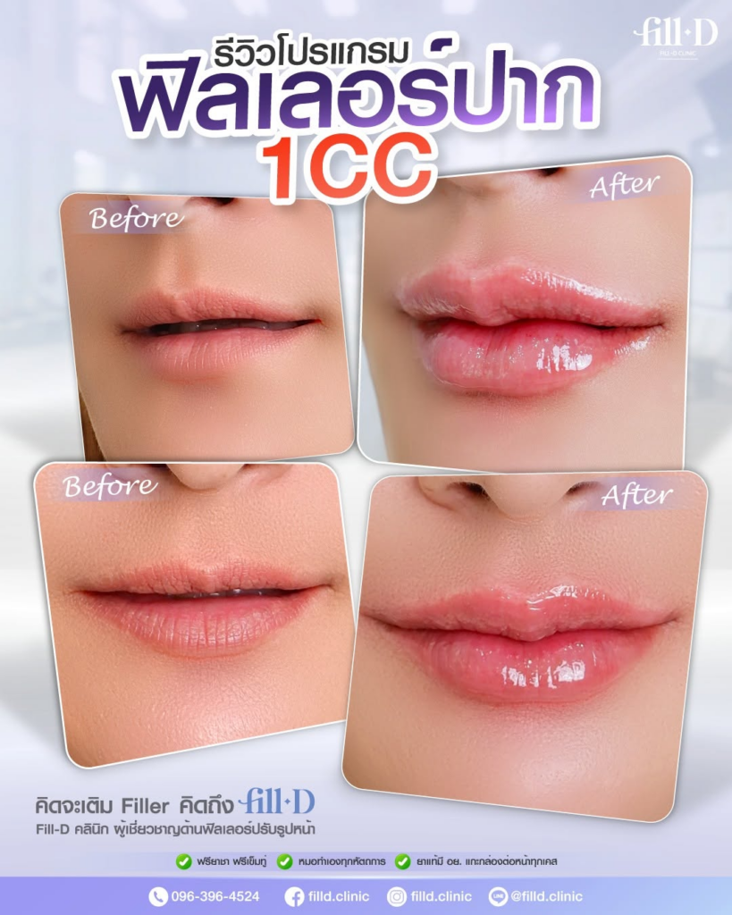 รีวิวคลินิกเสริมความงาม สุรินทร์ที่ Fill-D Clinic