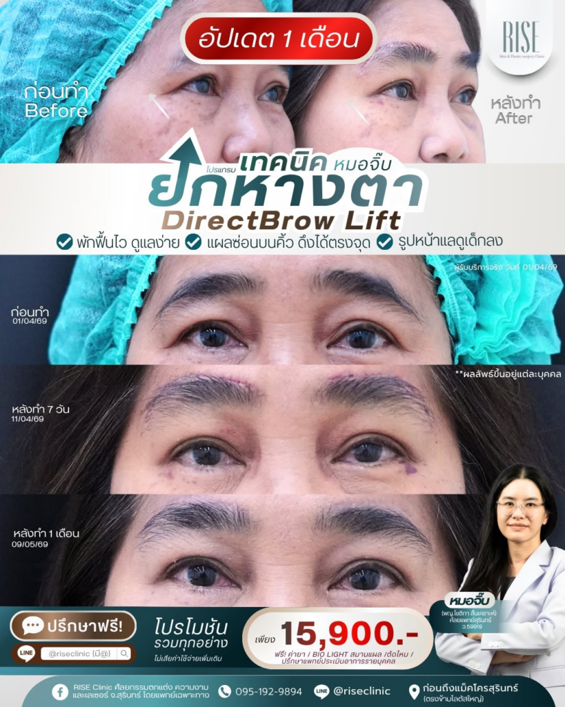 รีวิวคลินิกเสริมความงาม สุรินทร์ที่ RISE Clinic