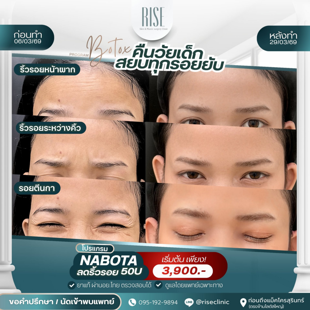 รีวิวคลินิกเสริมความงาม สุรินทร์ที่ RISE Clinic