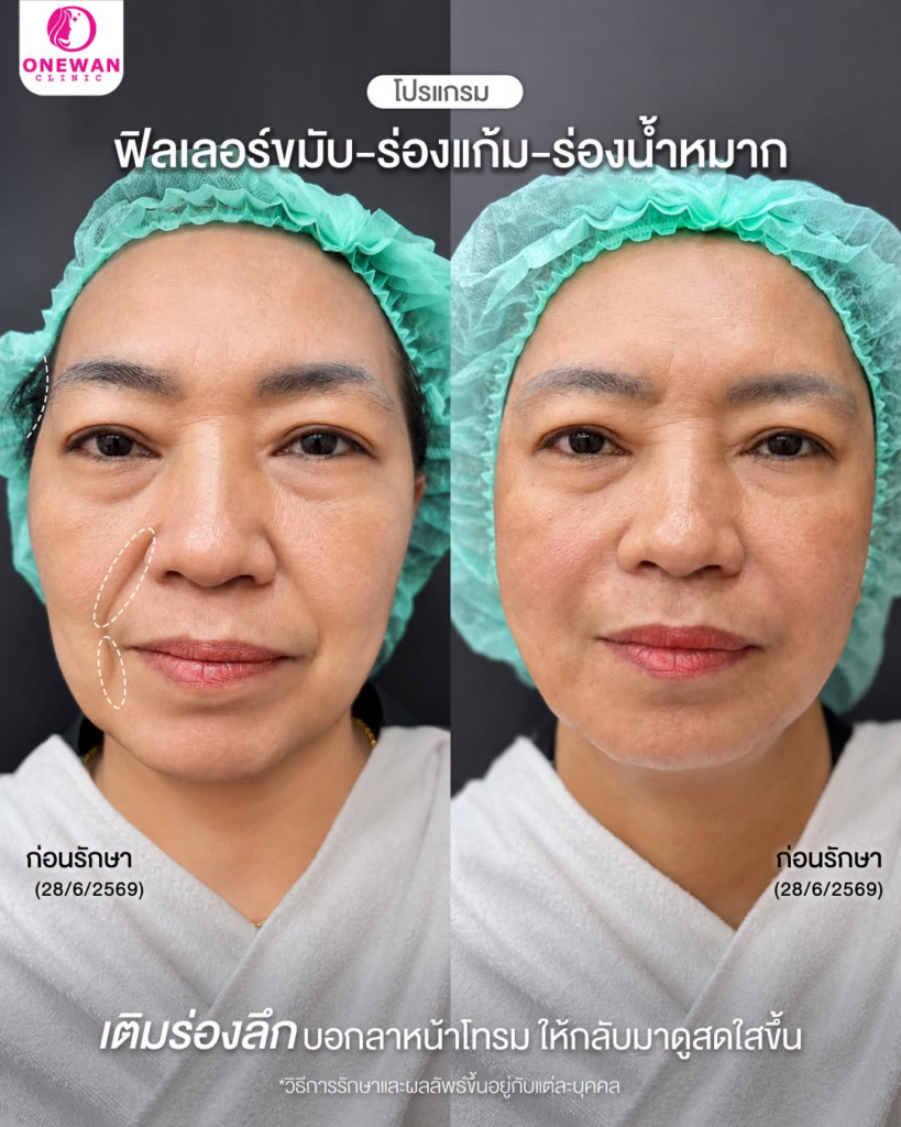รีวิวคลินิกเสริมความงาม สุรินทร์ที่ Onewan Clinic