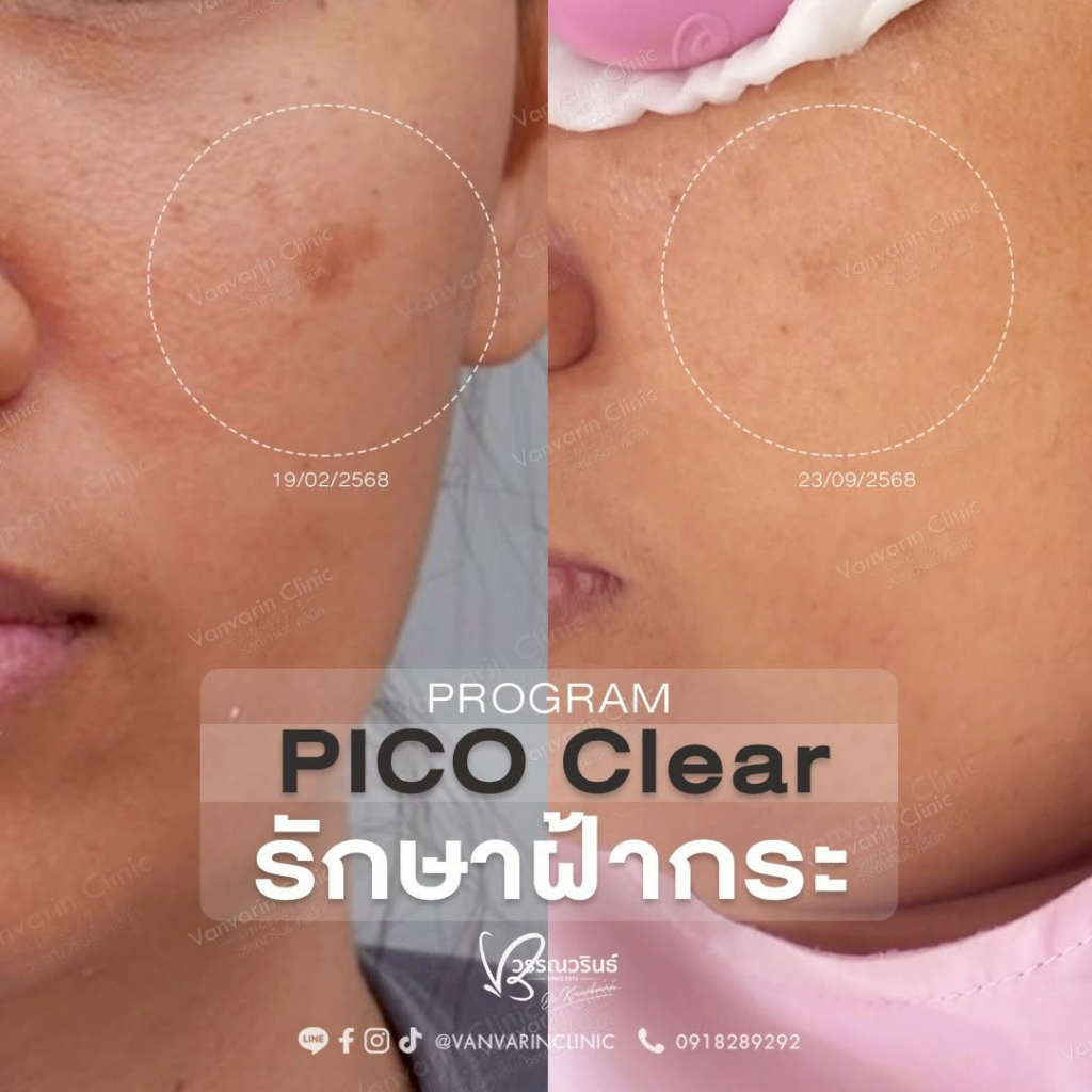 รีวิวคลินิกเสริมความงาม สุรินทร์ที่ Vanvarin Clinic