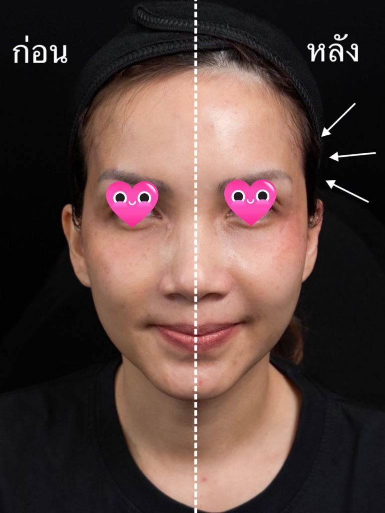 รีวิวคลินิกเสริมความงาม สุรินทร์ที่ Vanvarin Clinic