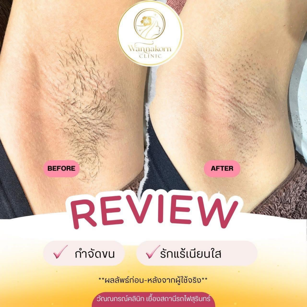 รีวิวคลินิกเสริมความงาม สุรินทร์ที่ Wannakorn Clinic
