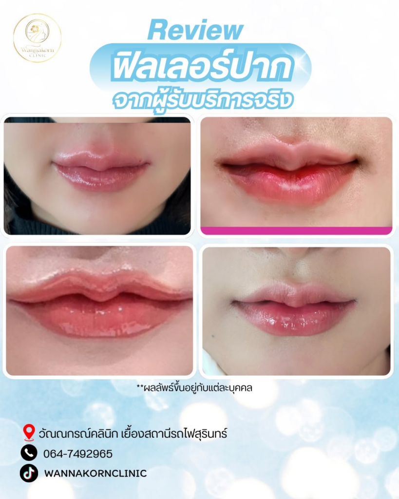 รีวิวคลินิกเสริมความงาม สุรินทร์ที่ Wannakorn Clinic