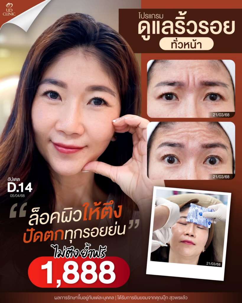 รีวิวคลินิกเสริมความงาม สุรินทร์ที่ UD Clinic