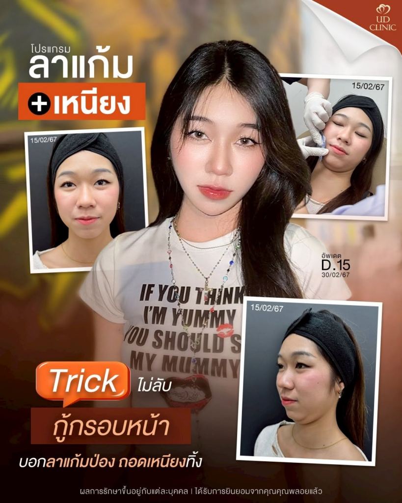 รีวิวคลินิกเสริมความงาม สุรินทร์ที่ UD Clinic