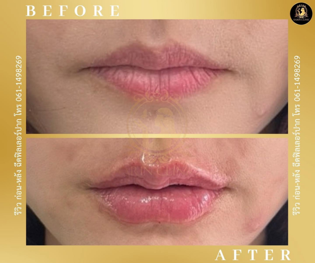 รีวิวคลินิกเสริมความงาม สุรินทร์ที่ Sarin Clinic