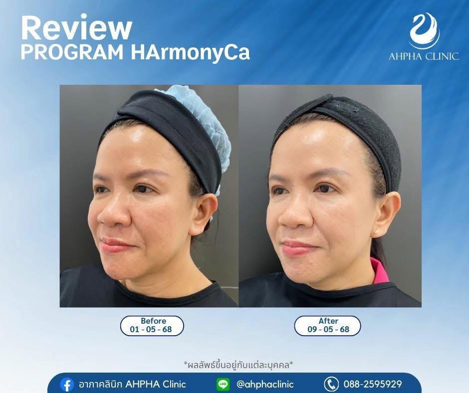 รีวิวคลินิกเสริมความงาม สุรินทร์ที่ AHPHA Clinic