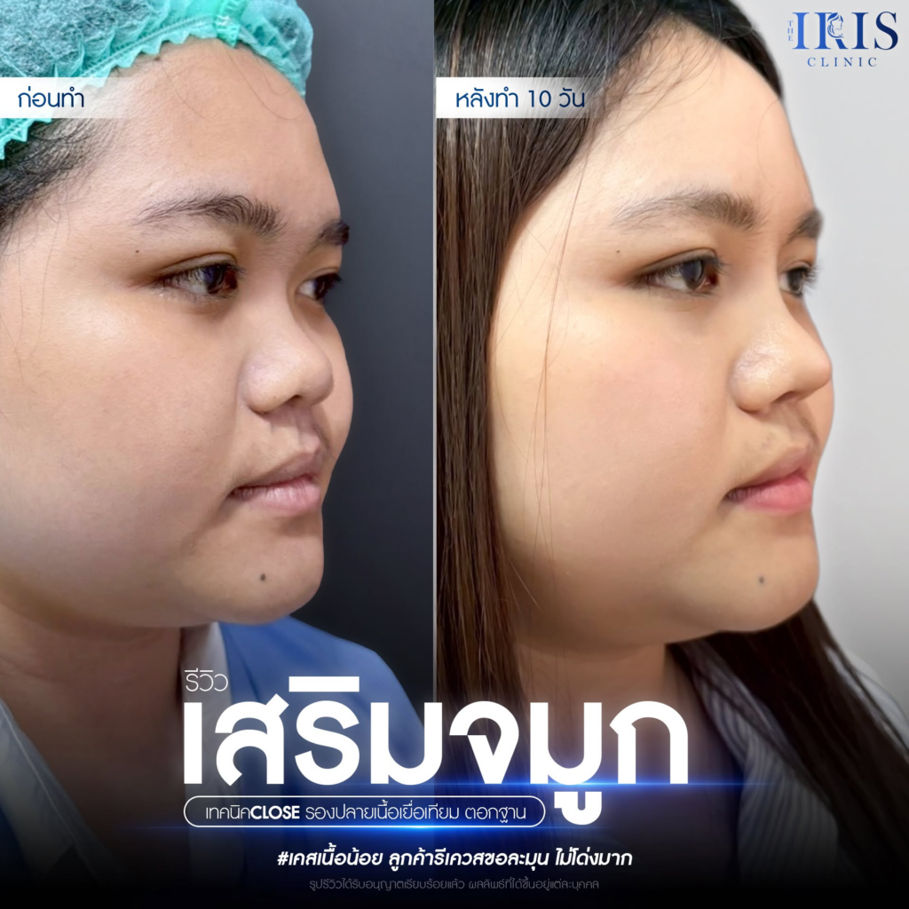 รีวิวคลินิกเสริมความงาม สุรินทร์ที่ The iris clinic