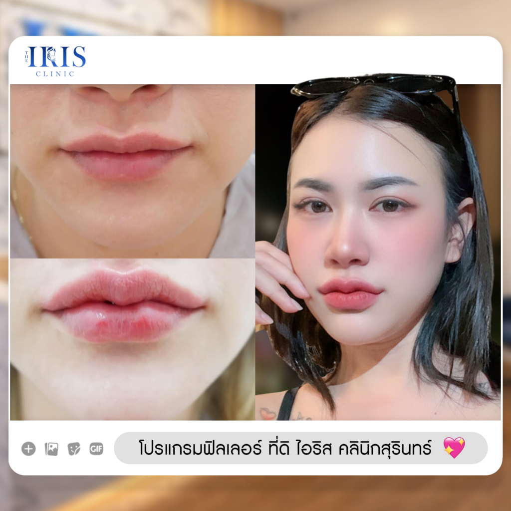รีวิวคลินิกเสริมความงาม สุรินทร์ที่ The iris clinic