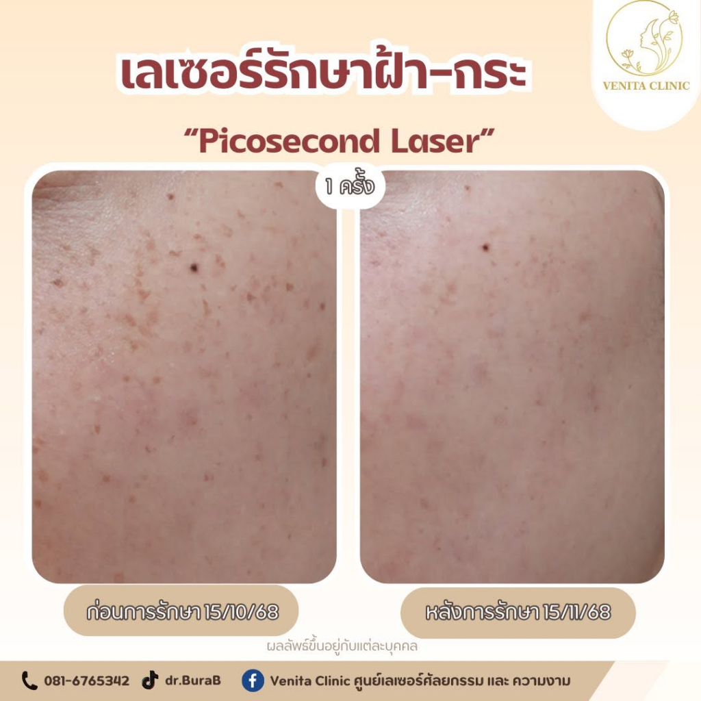 รีวิวคลินิกเสริมความงาม หนองคาย VENITA CLINIC