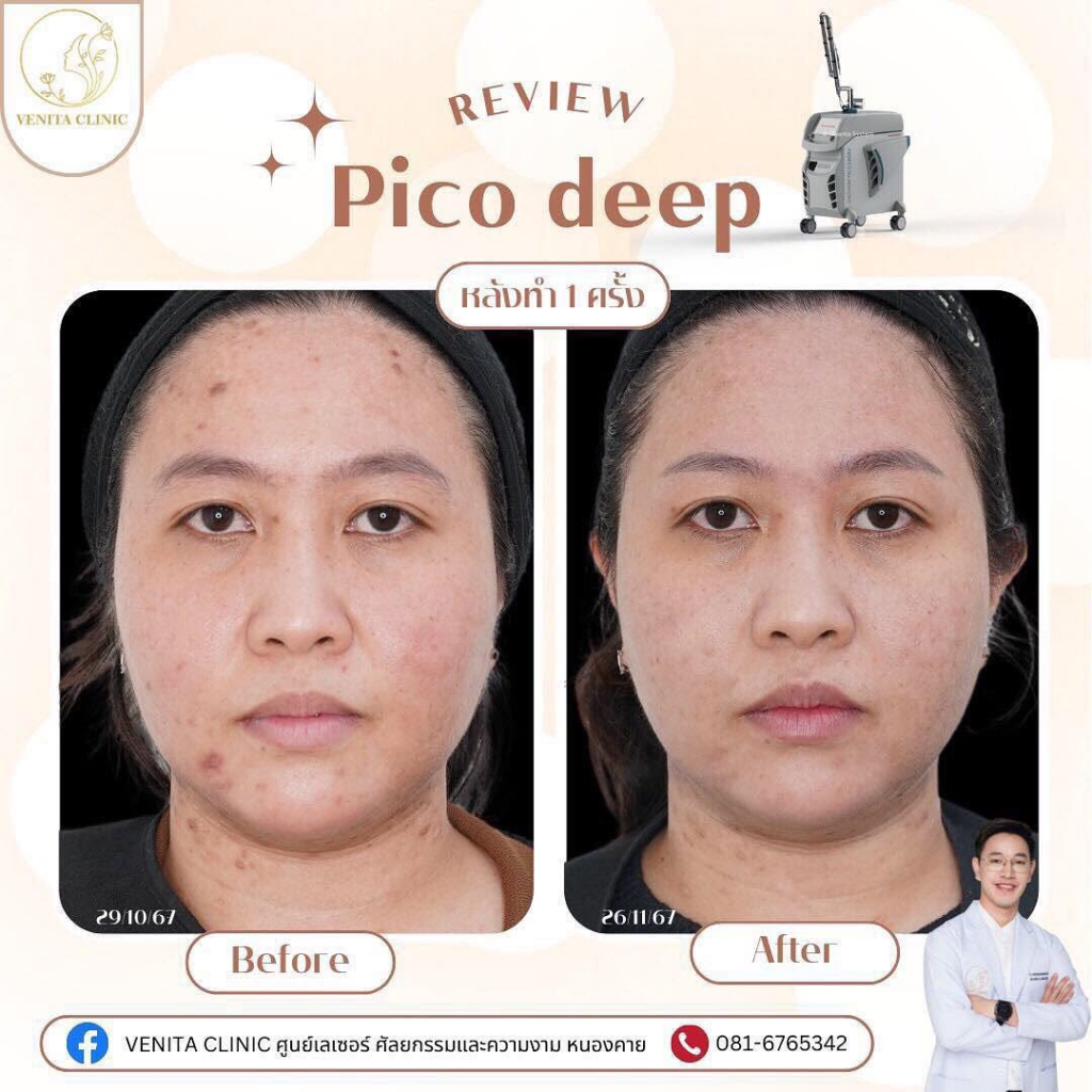 รีวิวคลินิกเสริมความงาม หนองคาย VENITA CLINIC