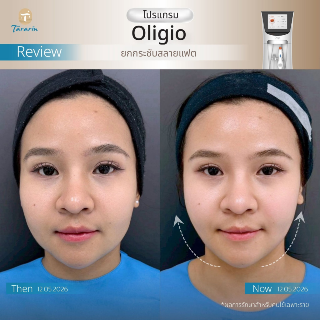รีวิวคลินิกเสริมความงาม มหาสารคาม ธารารินคลินิก