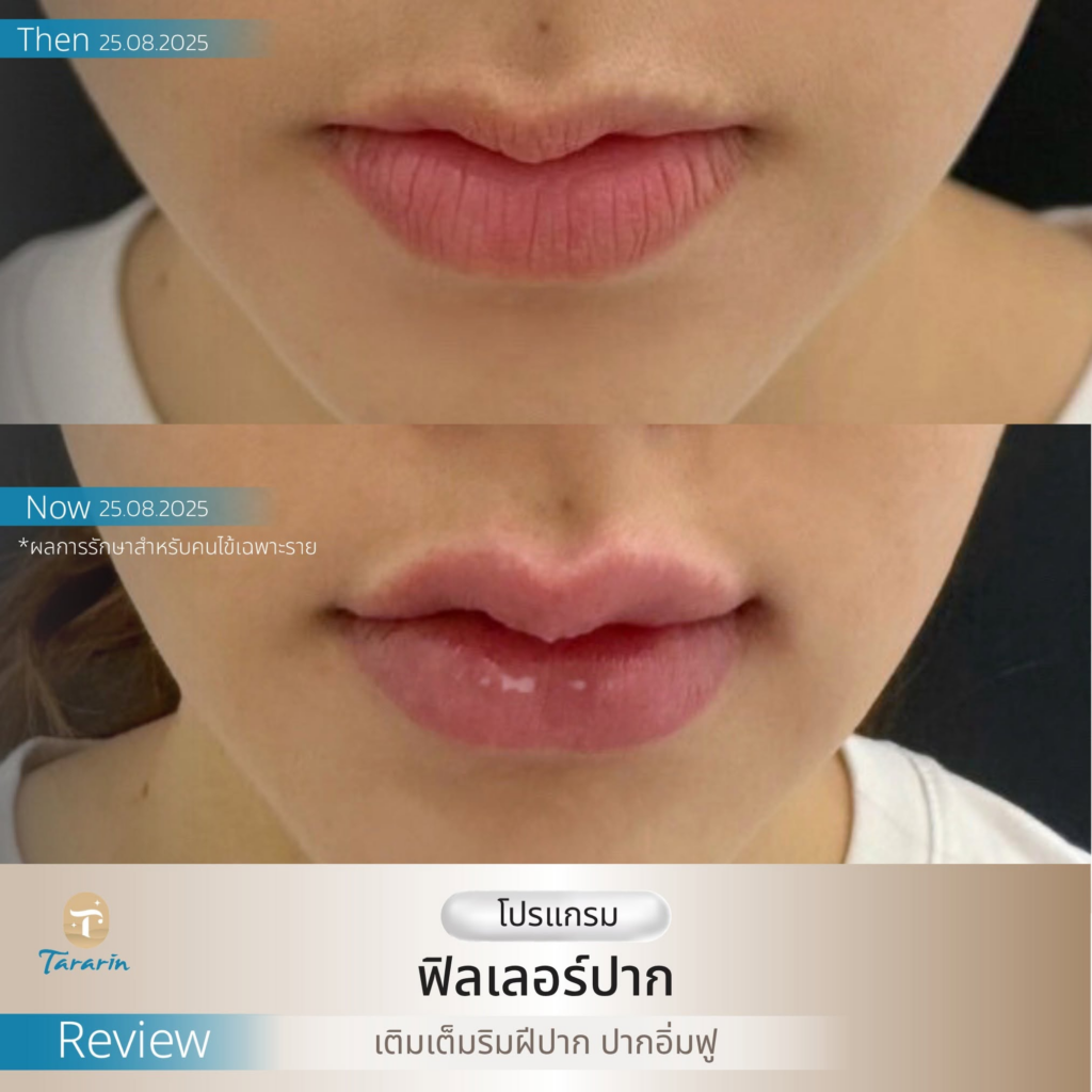 รีวิวคลินิกเสริมความงาม มหาสารคาม ธารารินคลินิก