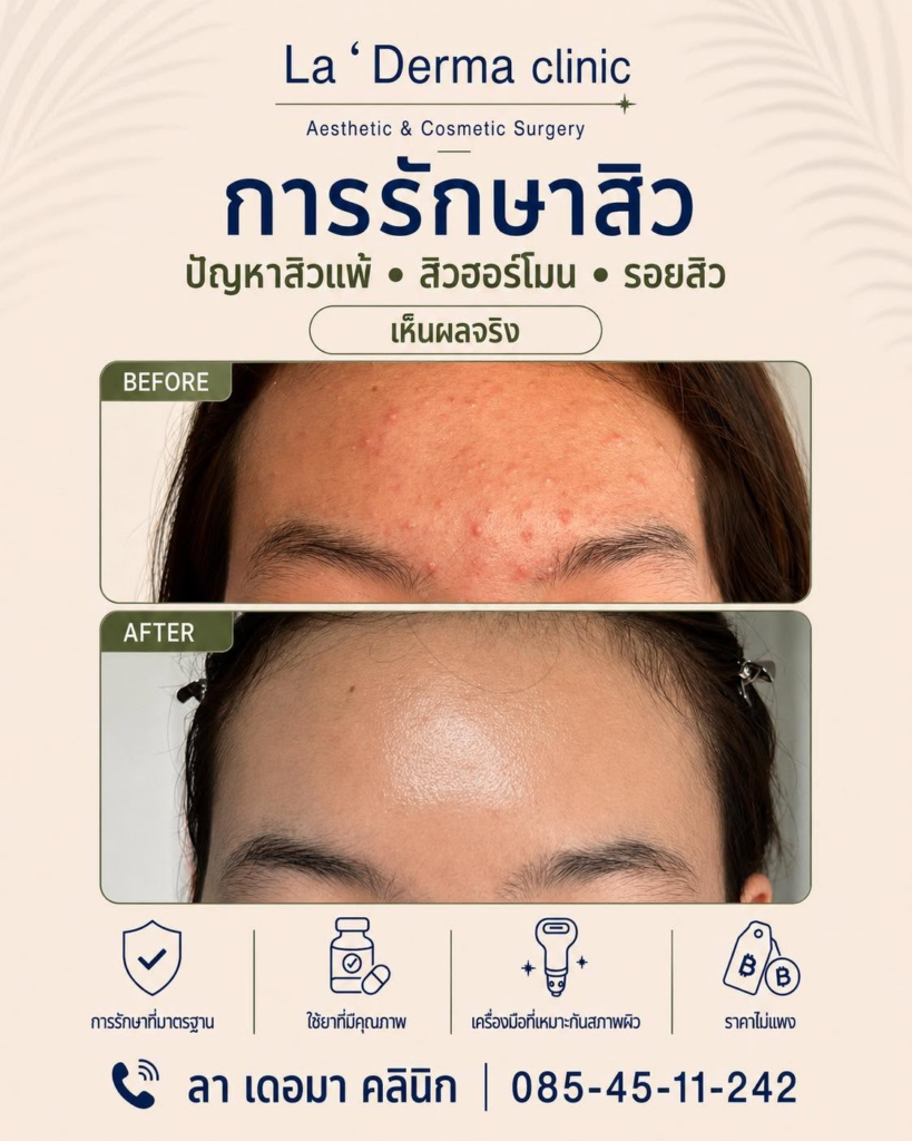 รีวิวคลินิกเสริมความงาม มหาสารคาม ลาเดอมา คลินิก Art & Surgery