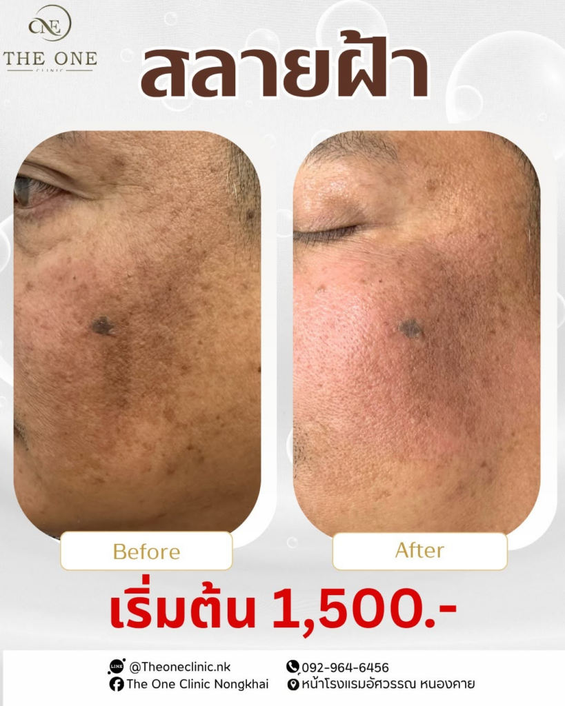 รีวิวคลินิกเสริมความงาม หนองคาย The One Clinic