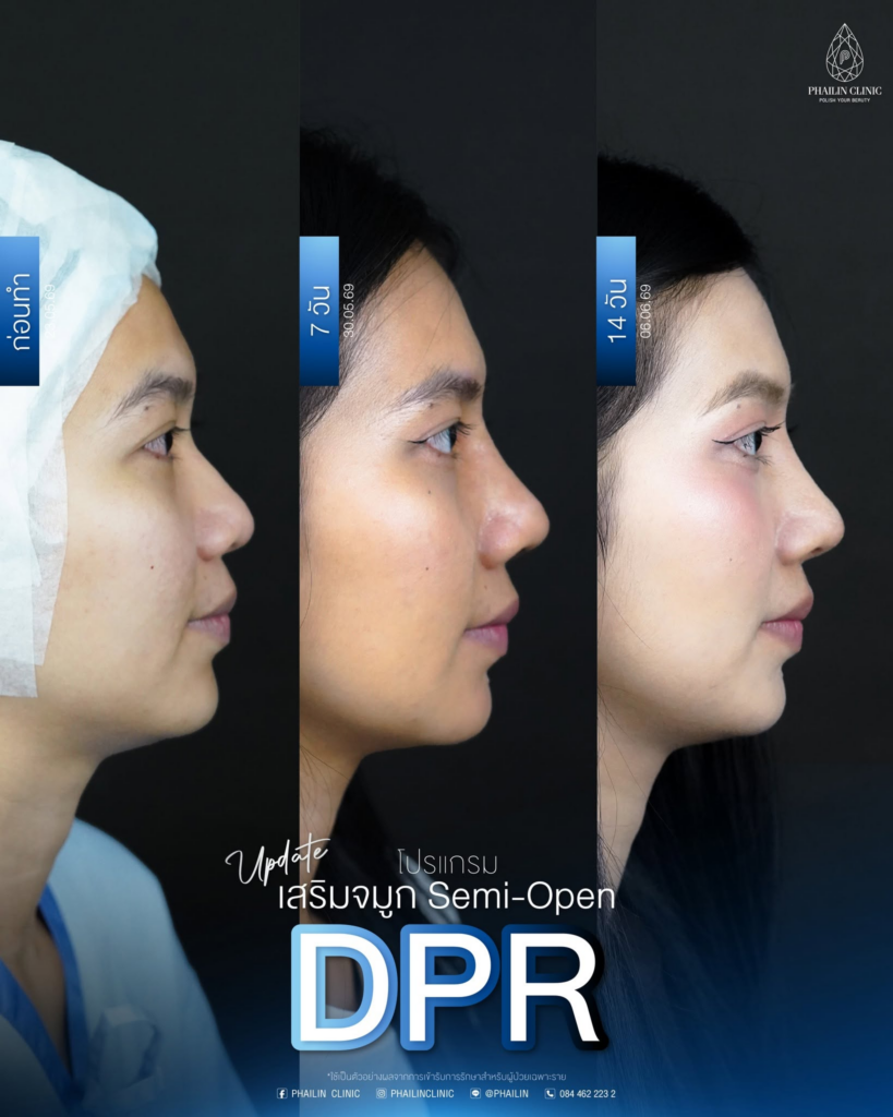 รีวิวคลินิกเสริมความงาม มหาสารคาม Phailin clinic