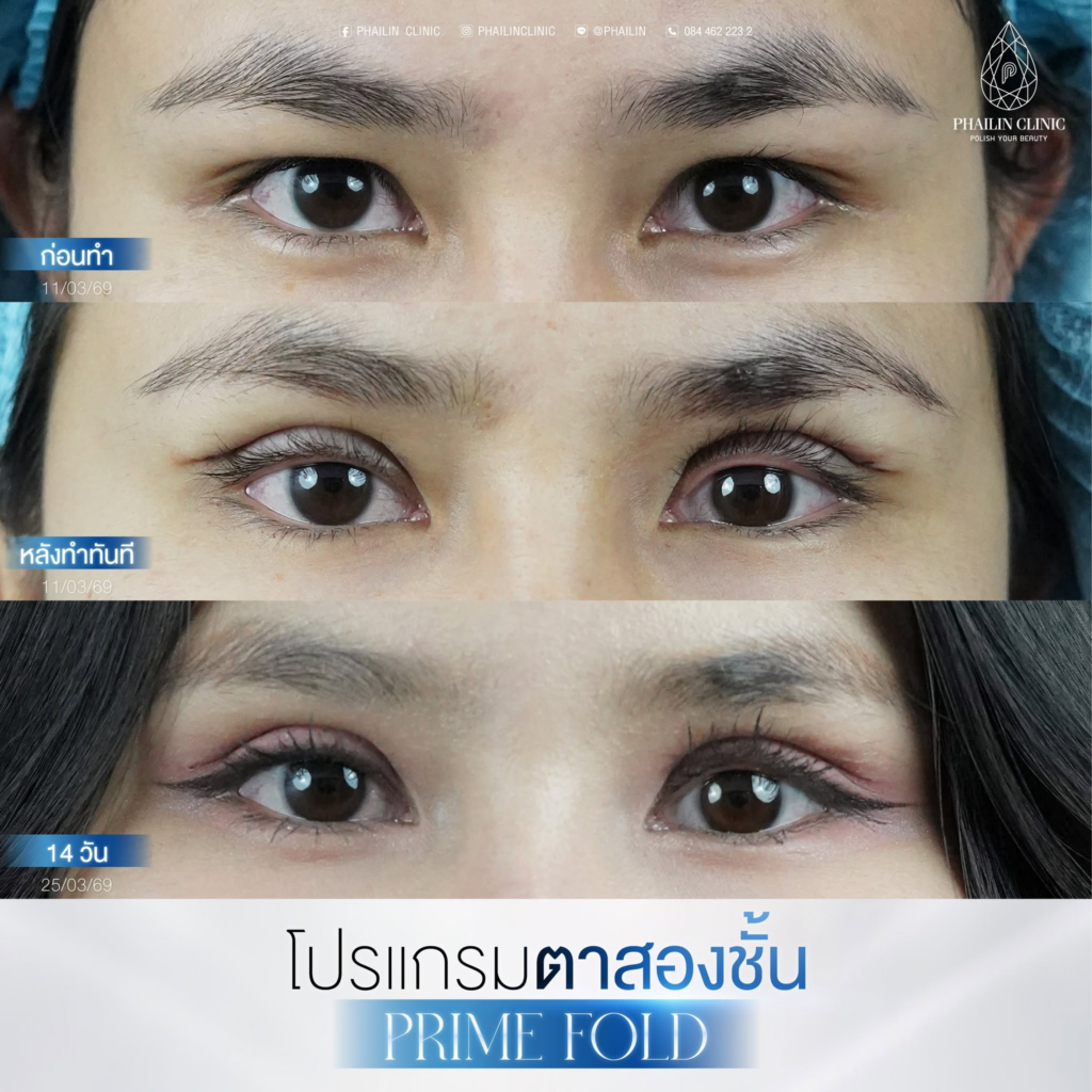 รีวิวคลินิกเสริมความงาม มหาสารคาม Phailin clinic