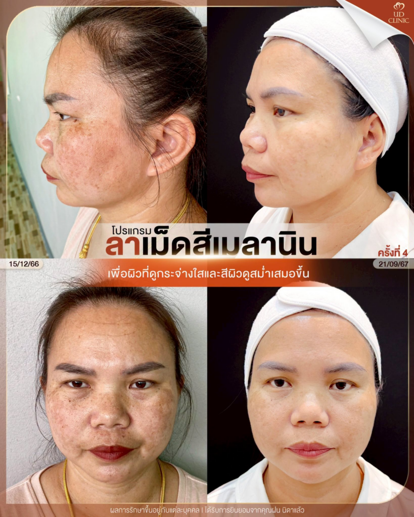 รีวิวคลินิกเสริมความงาม มหาสารคาม UD Clinic