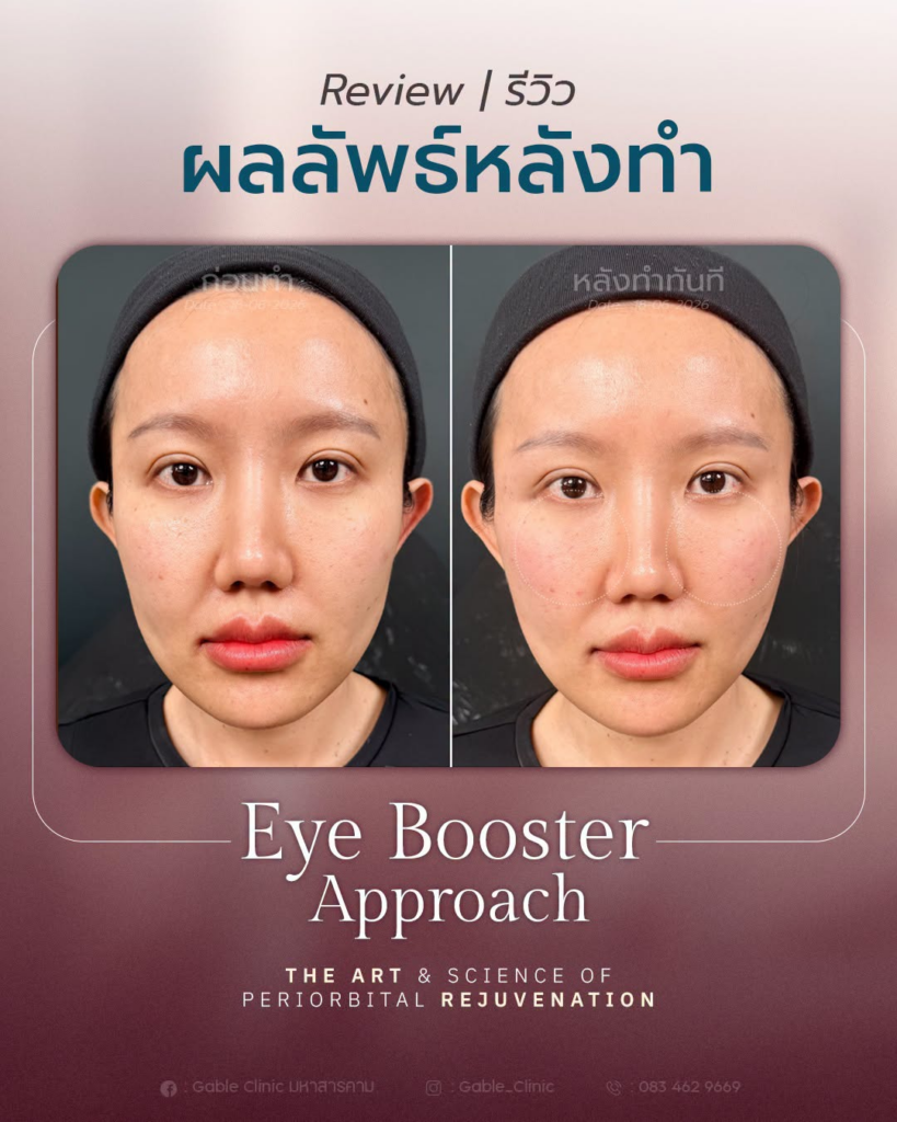 รีวิวคลินิกเสริมความงาม มหาสารคาม Gable Clinic