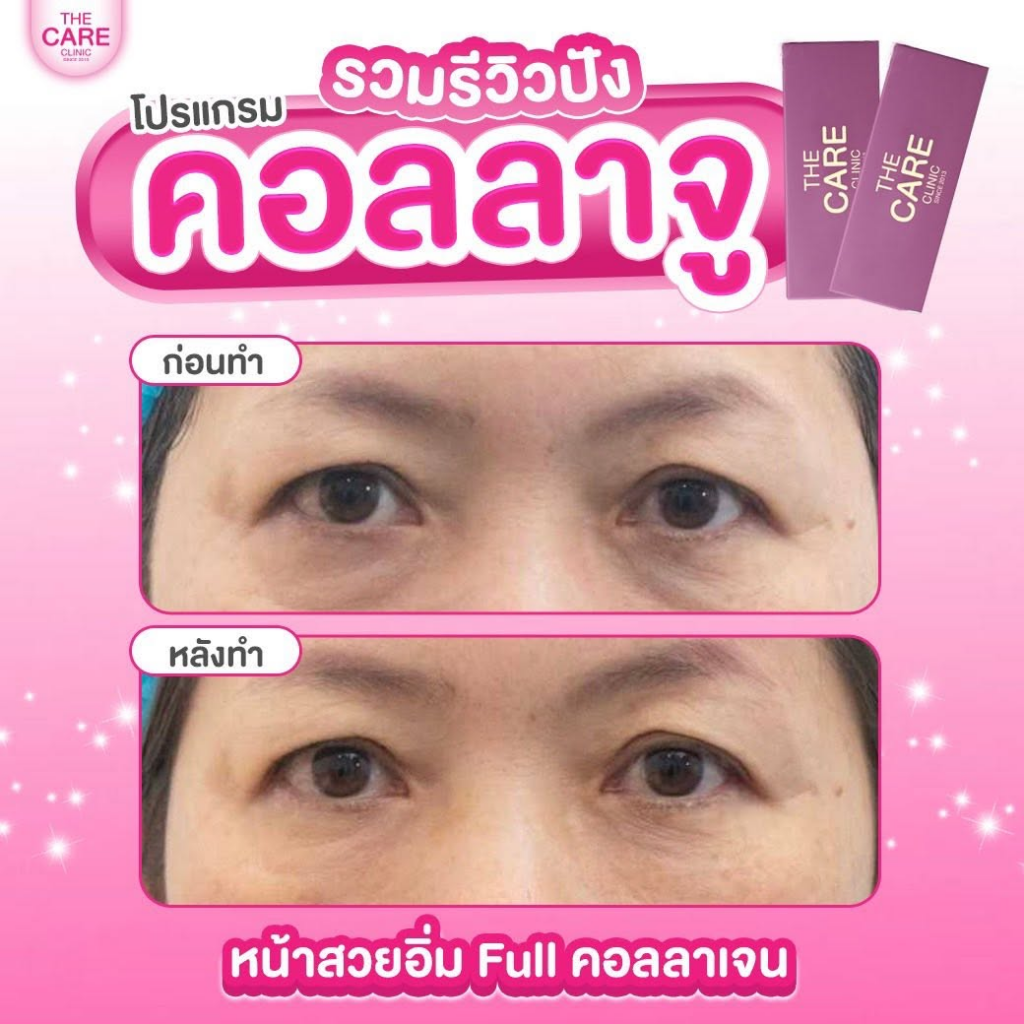 รีวิวคลินิกเสริมความงาม มหาสารคาม เดอะแคร์คลินิกฟ