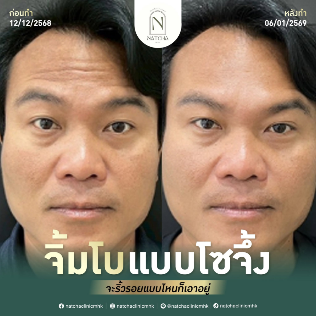 รีวิวคลินิกเสริมความงาม มหาสารคาม Natcha clinic