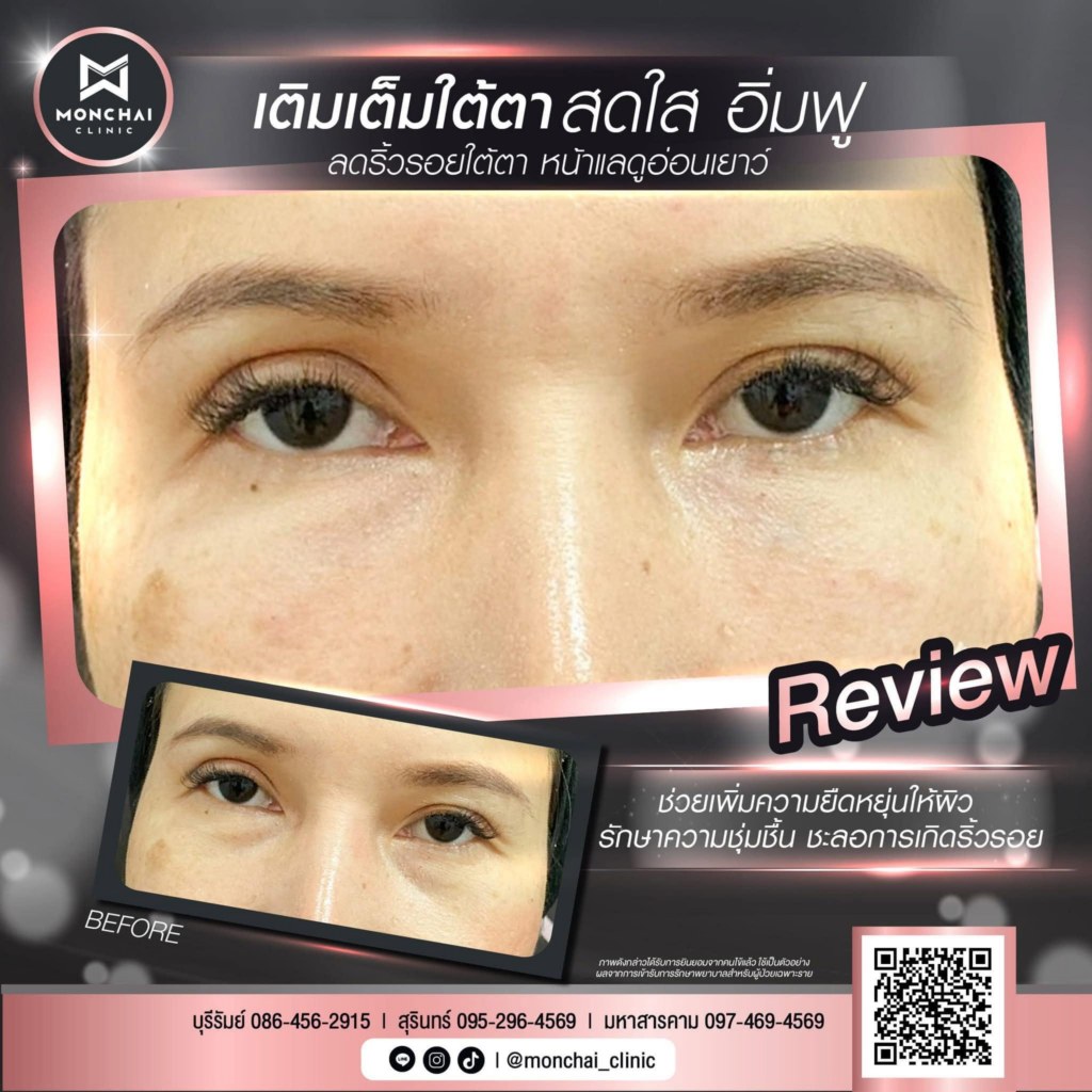 รีวิวคลินิกเสริมความงาม มหาสารคาม มนต์ชัยคลินิก