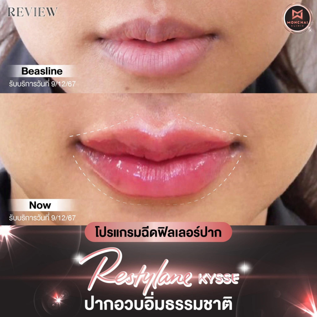 รีวิวคลินิกเสริมความงาม มหาสารคาม มนต์ชัยคลินิก