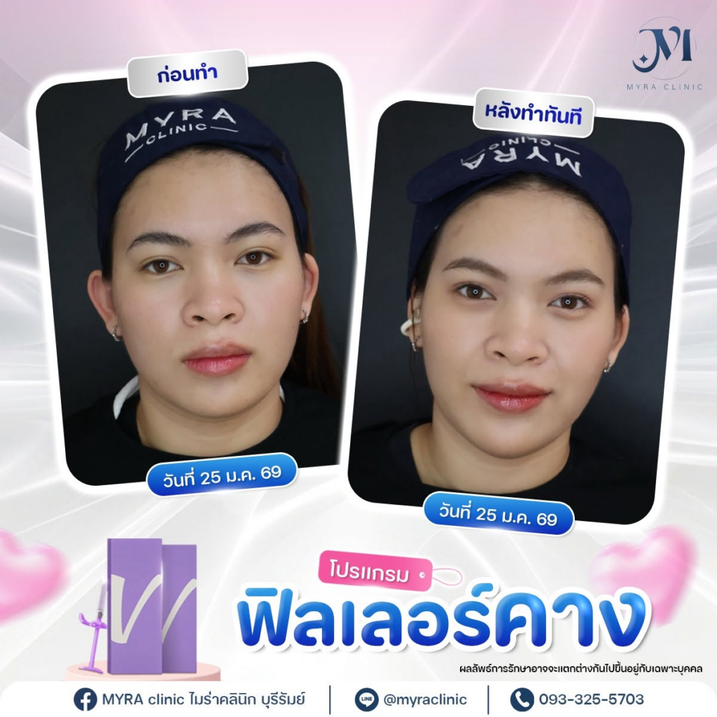 รีวิวคลินิกเสริมความงามบุรีรัมย์ที่ MYRA Clinic