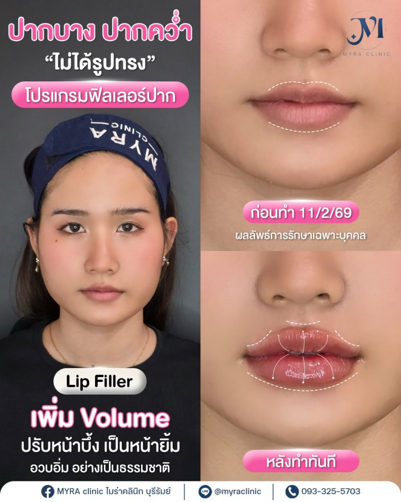 รีวิวคลินิกเสริมความงามบุรีรัมย์ที่ MYRA Clinic
