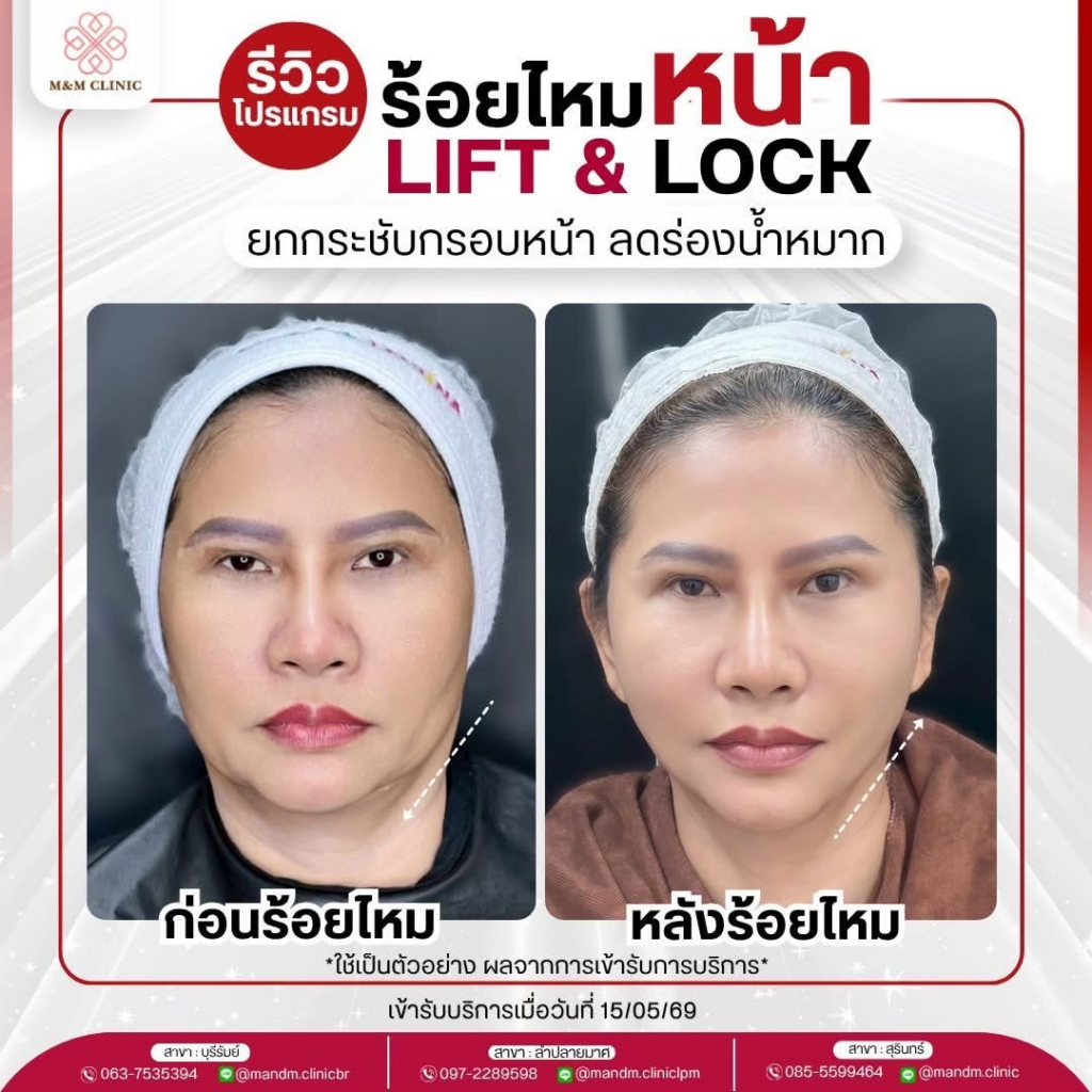 รีวิวคลินิกเสริมความงามบุรีรัมย์ที่ M&M Clinic by คุณหมอมิว