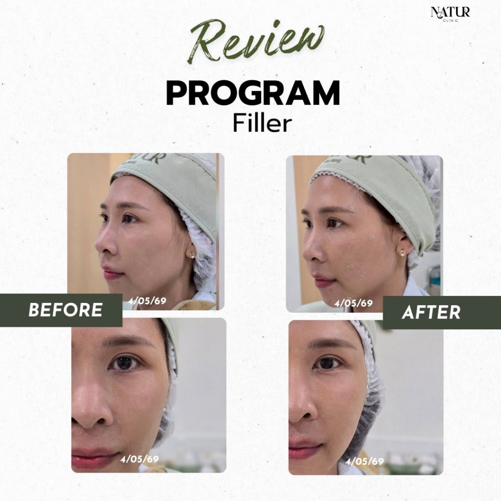 รีวิวคลินิกเสริมความงามบุรีรัมย์ที่ Natur Clinic