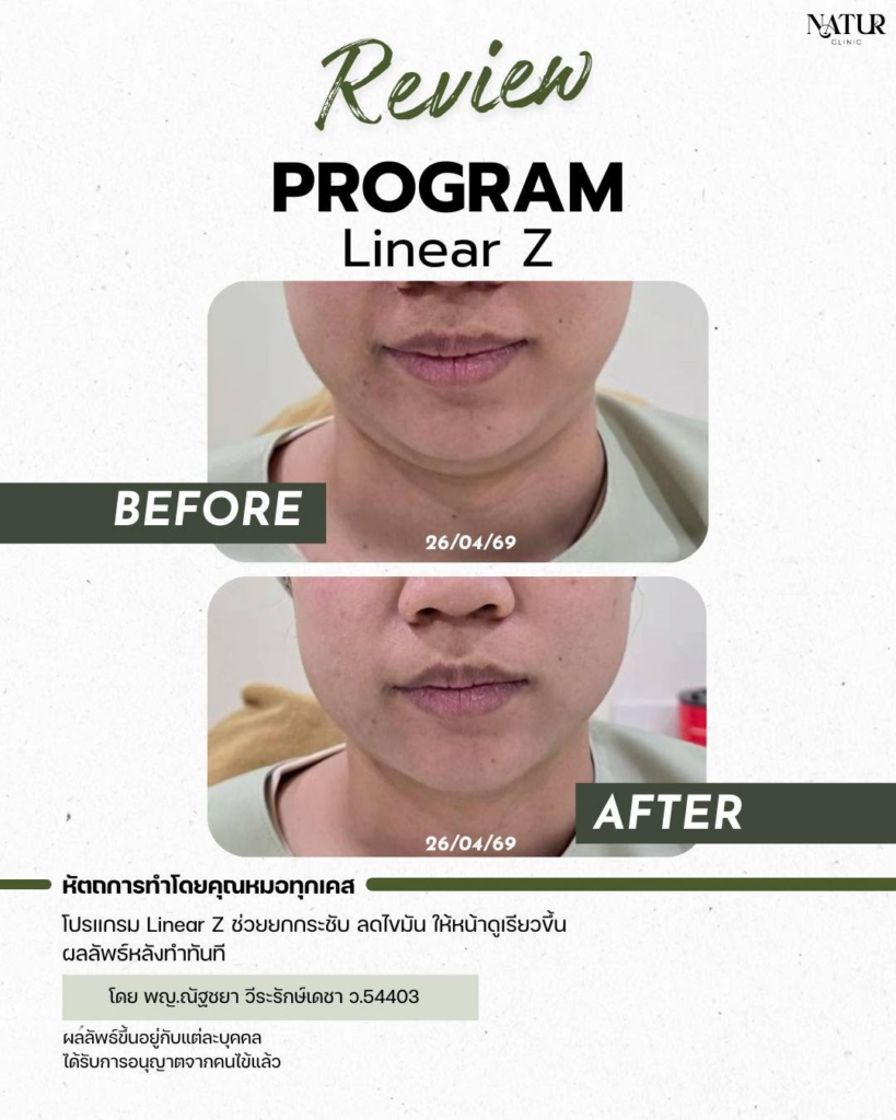รีวิวคลินิกเสริมความงามบุรีรัมย์ที่ Natur Clinic