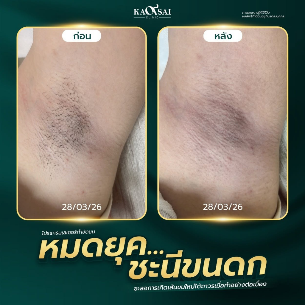 รีวิวคลินิกเสริมความงามบุรีรัมย์ที่ ก้าวใส คลินิก