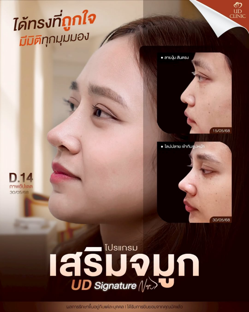 รีวิวคลินิกเสริมความงามบุรีรัมย์ที่ UD Clinic