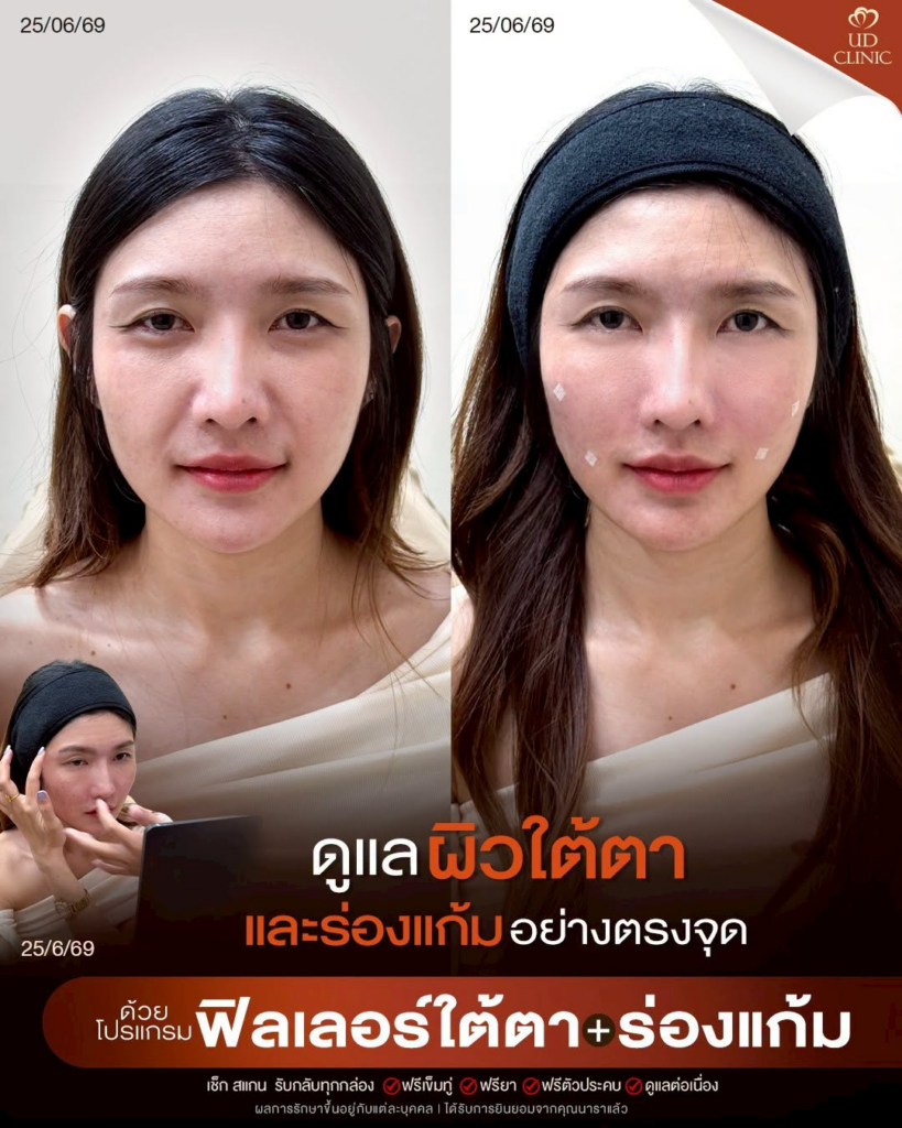รีวิวคลินิกเสริมความงามบุรีรัมย์ที่ UD Clinic