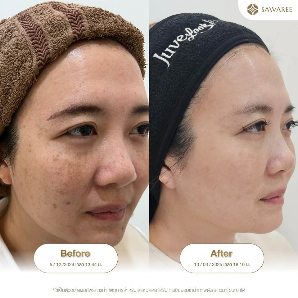 รีวิวคลินิกเสริมความงามบุรีรัมย์ที่ Saivaree Clinic