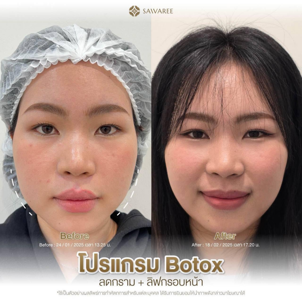 รีวิวคลินิกเสริมความงามบุรีรัมย์ที่ Saivaree Clinic