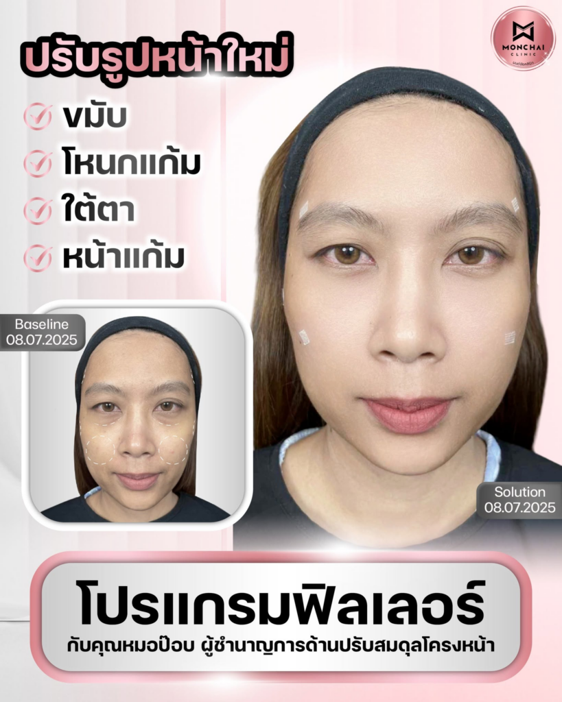 รีวิวคลินิกเสริมความงามบุรีรัมย์ที่ มนต์ชัยคลินิก