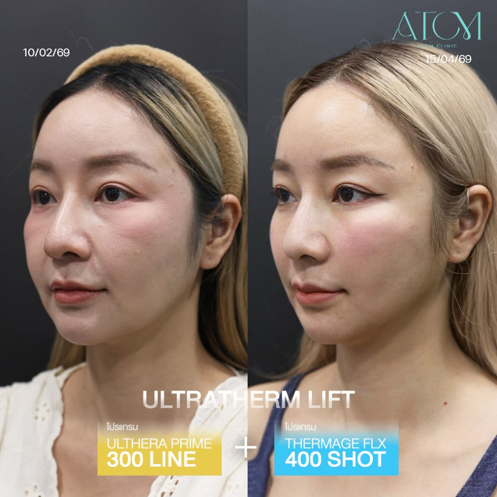 รีวิวคลินิกเสริมความงามบุรีรัมย์ที่ อะตอมคลินิก