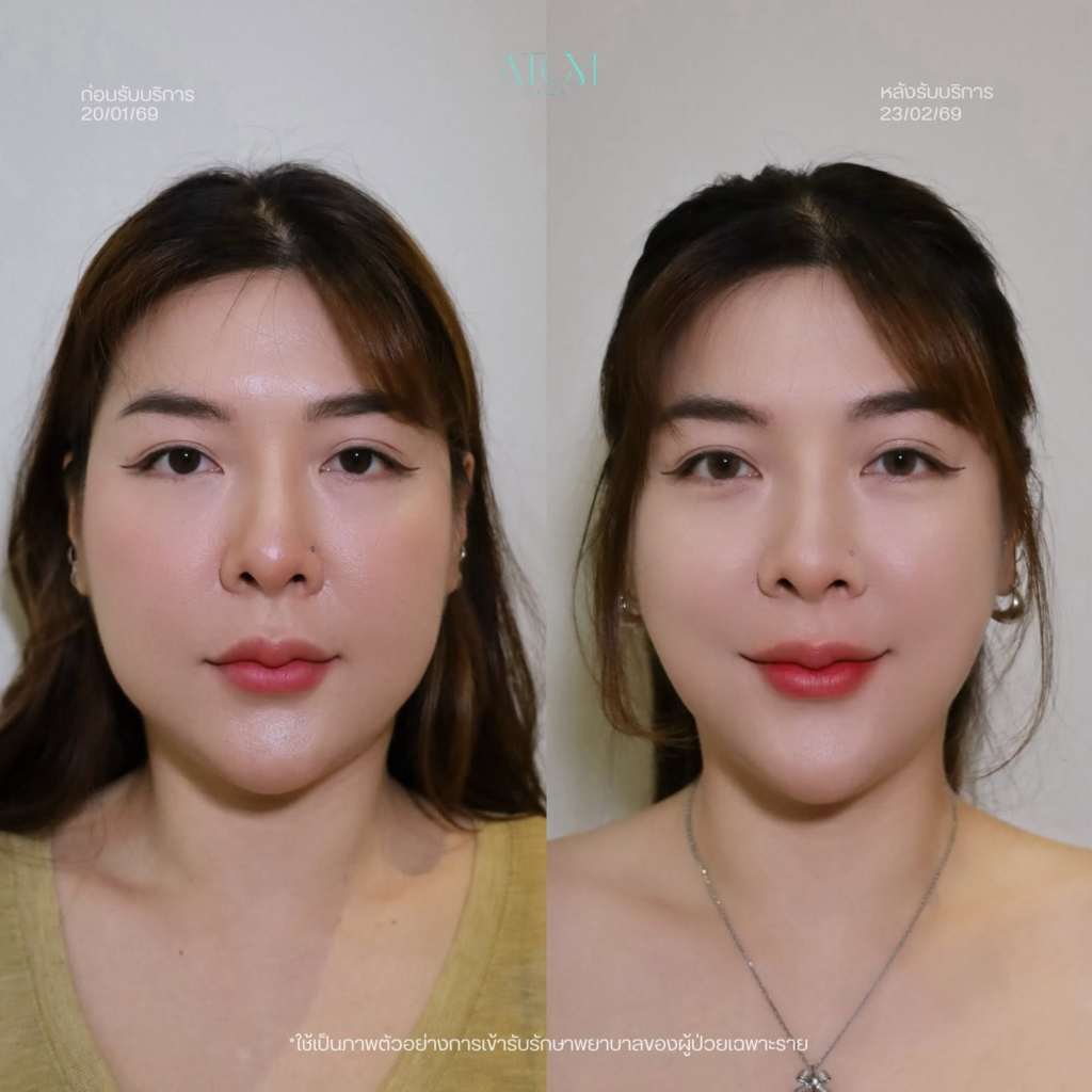 รีวิวคลินิกเสริมความงามบุรีรัมย์ที่ อะตอมคลินิก