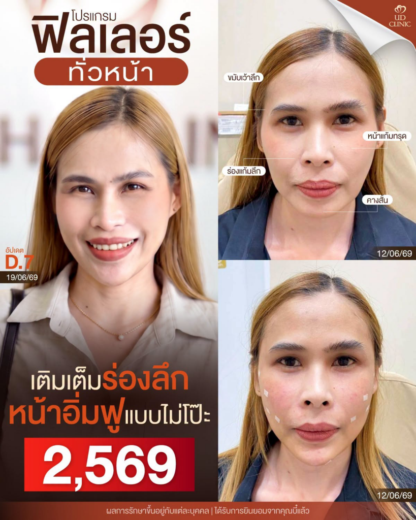 รีวิวคลินิกเสริมความงาม ร้อยเอ็ดที่ UD Clinic