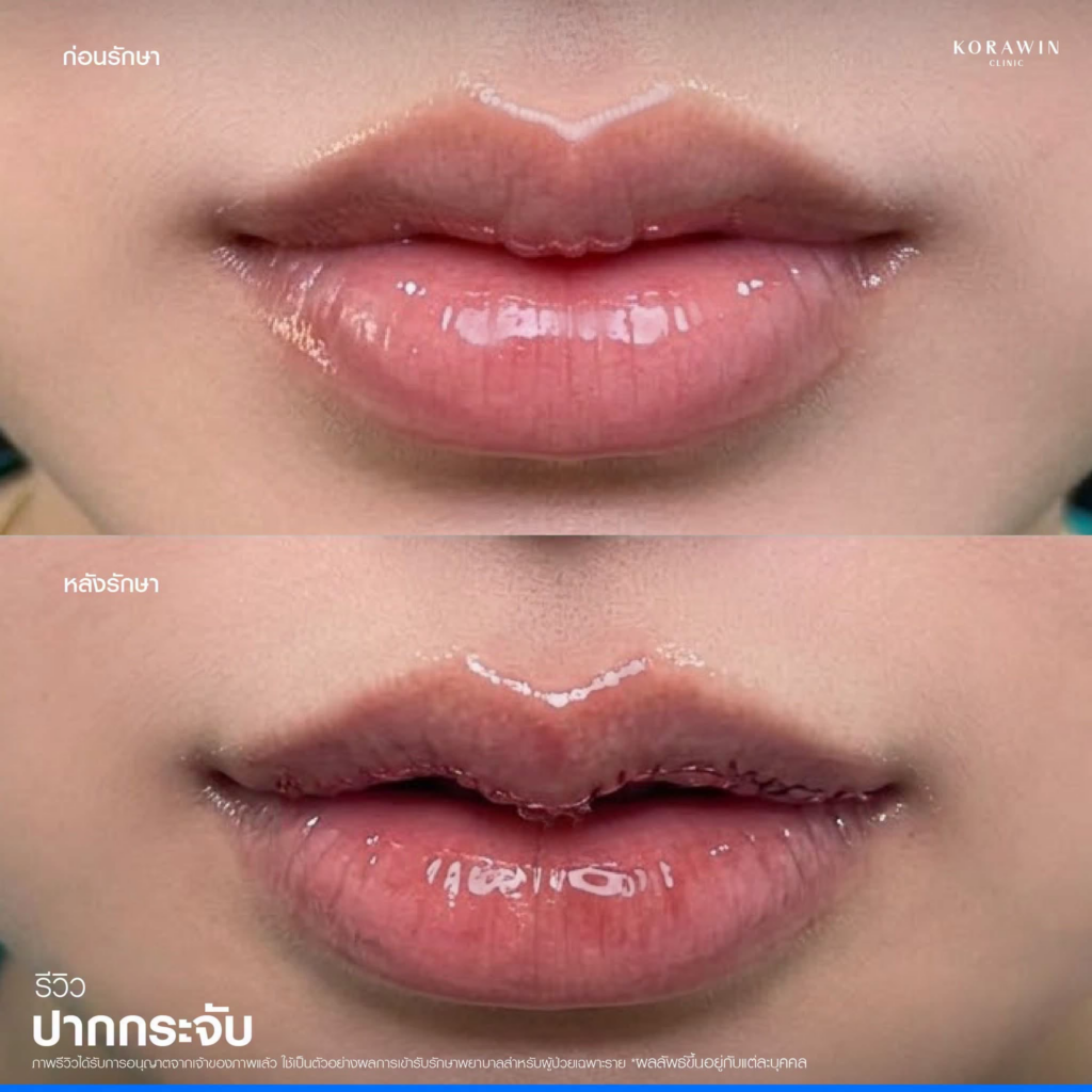 รีวิวคลินิกเสริมความงาม หนองคาย กรวินคลินิก