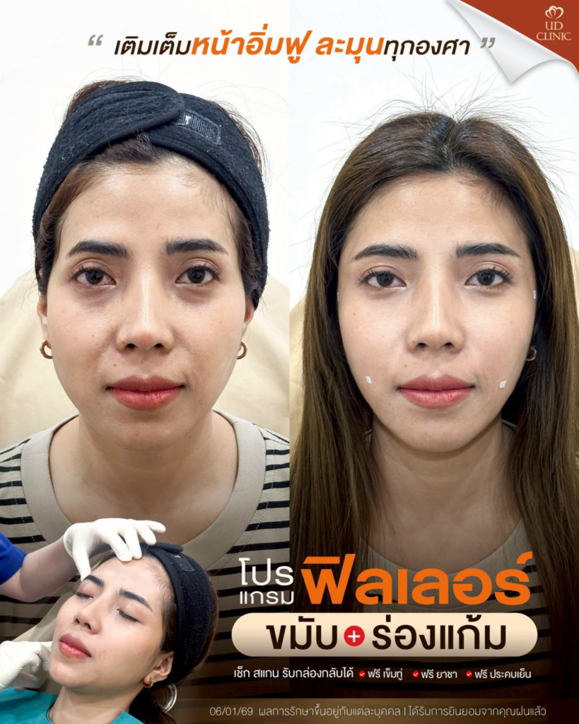 รีวิวคลินิกเสริมความงาม ร้อยเอ็ดที่ UD Clinic