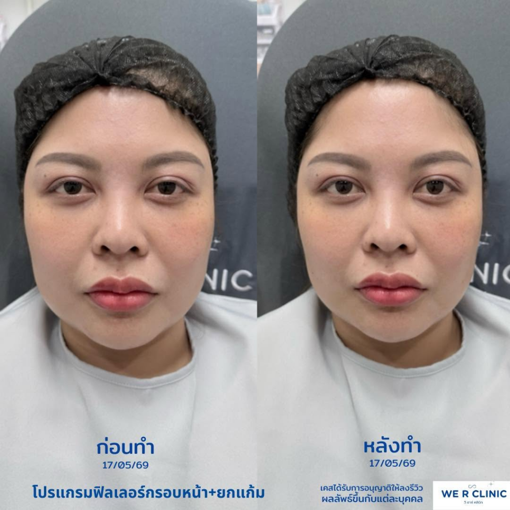 รีวิวคลินิกเสริมความงาม ร้อยเอ็ดที่ we r clinic