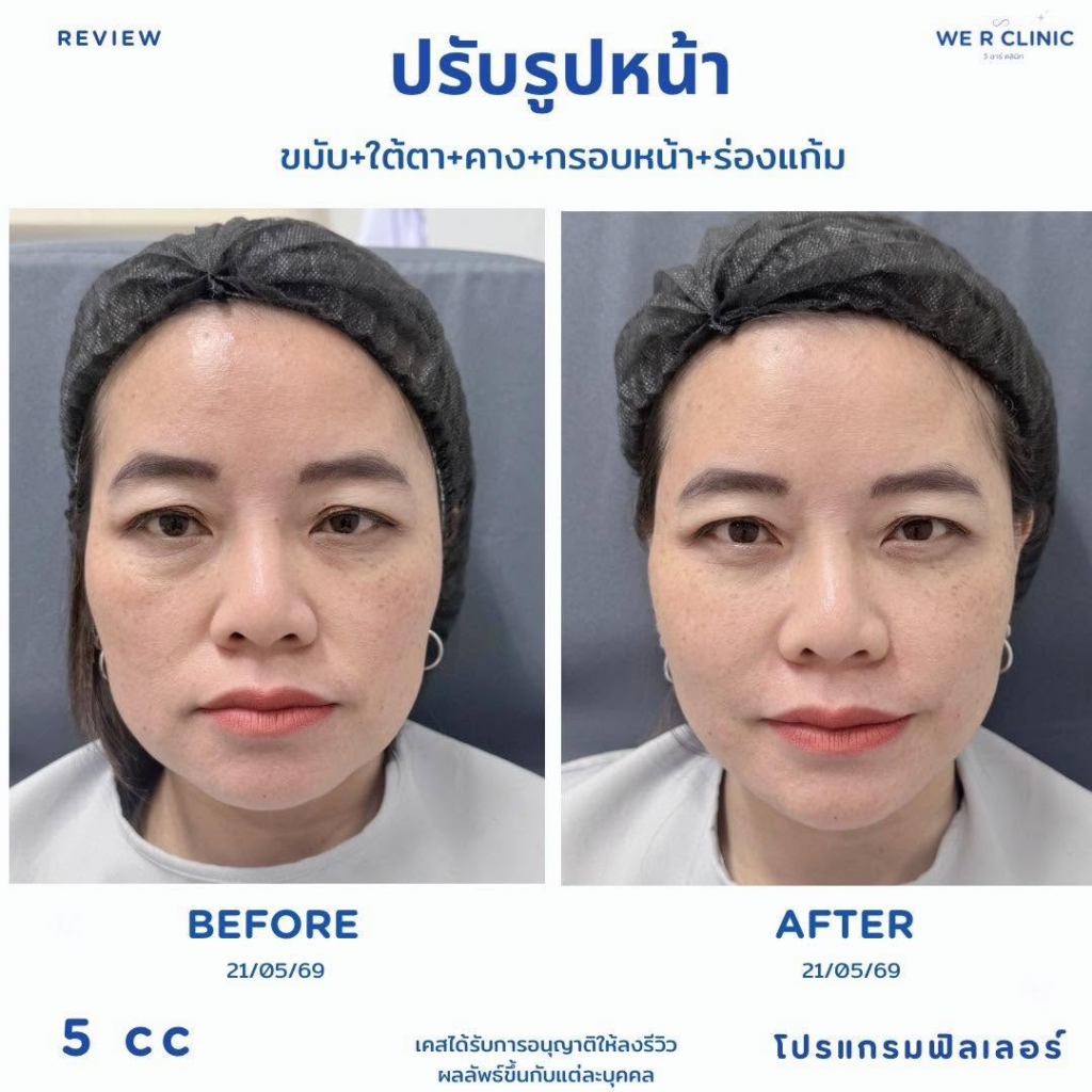 รีวิวคลินิกเสริมความงาม ร้อยเอ็ดที่ we r clinic