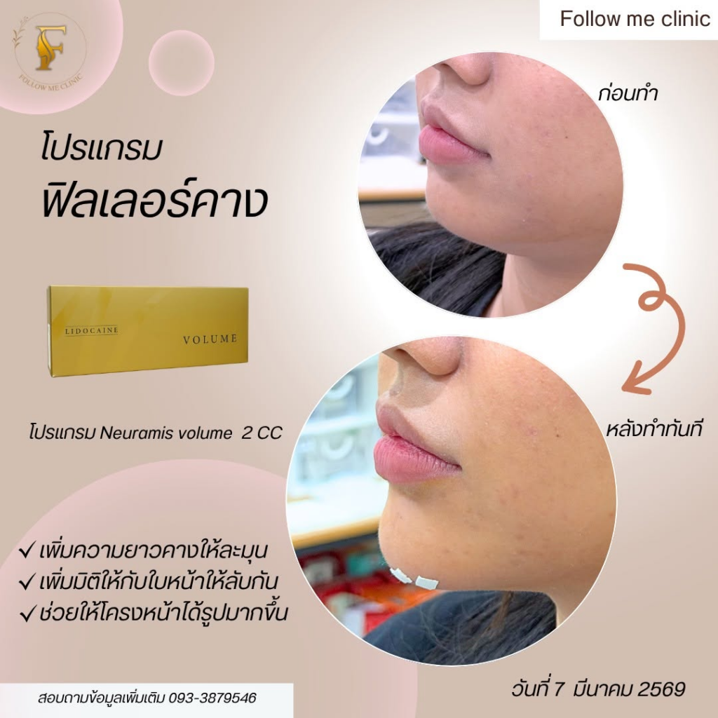 รีวิวคลินิกเสริมความงาม ร้อยเอ็ดที่ Follow me clinic