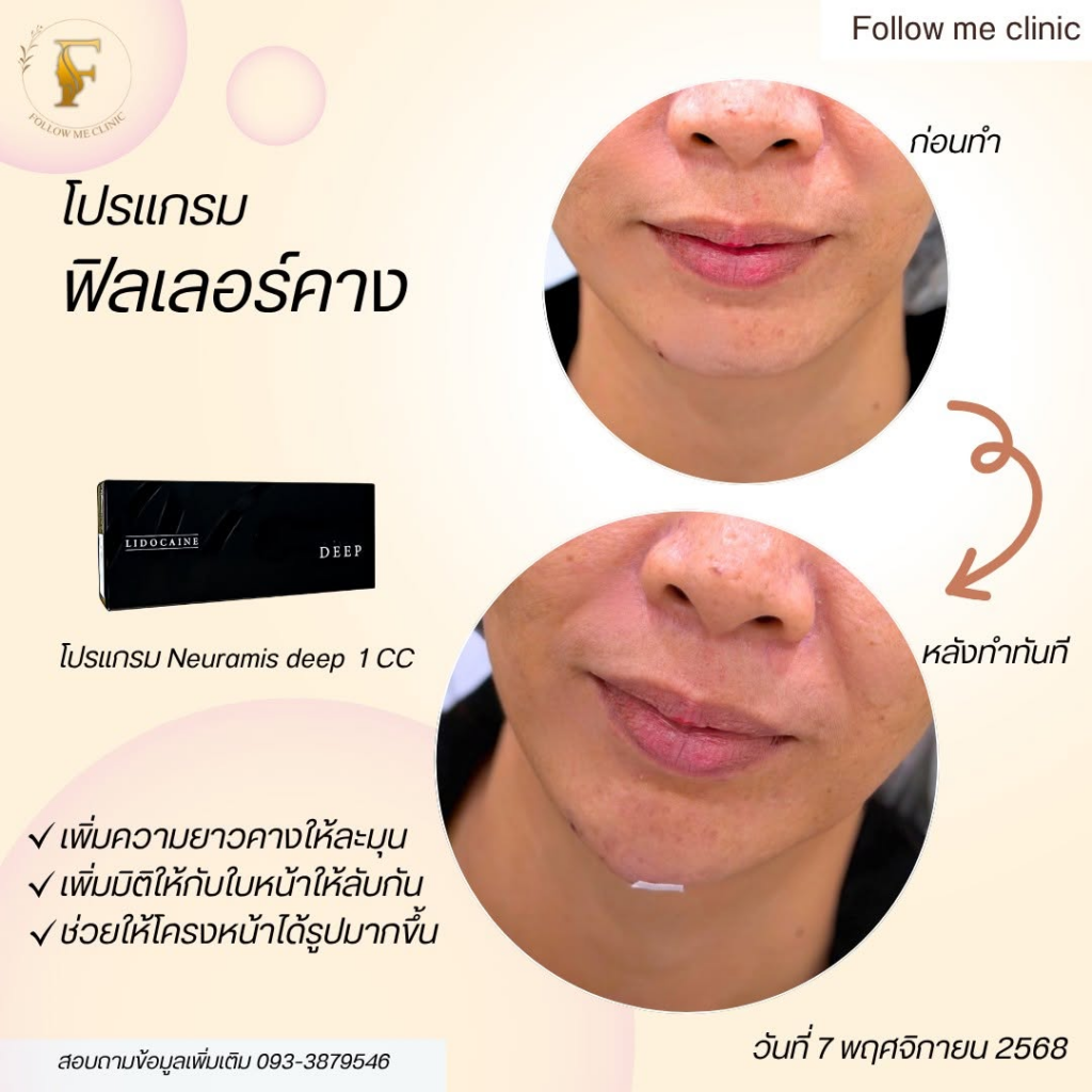 รีวิวคลินิกเสริมความงาม ร้อยเอ็ดที่ Follow me clinic