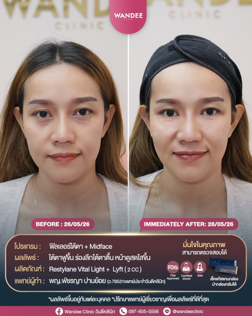 รีวิวคลินิกเสริมความงาม ร้อยเอ็ดที่ Wandee Clinic