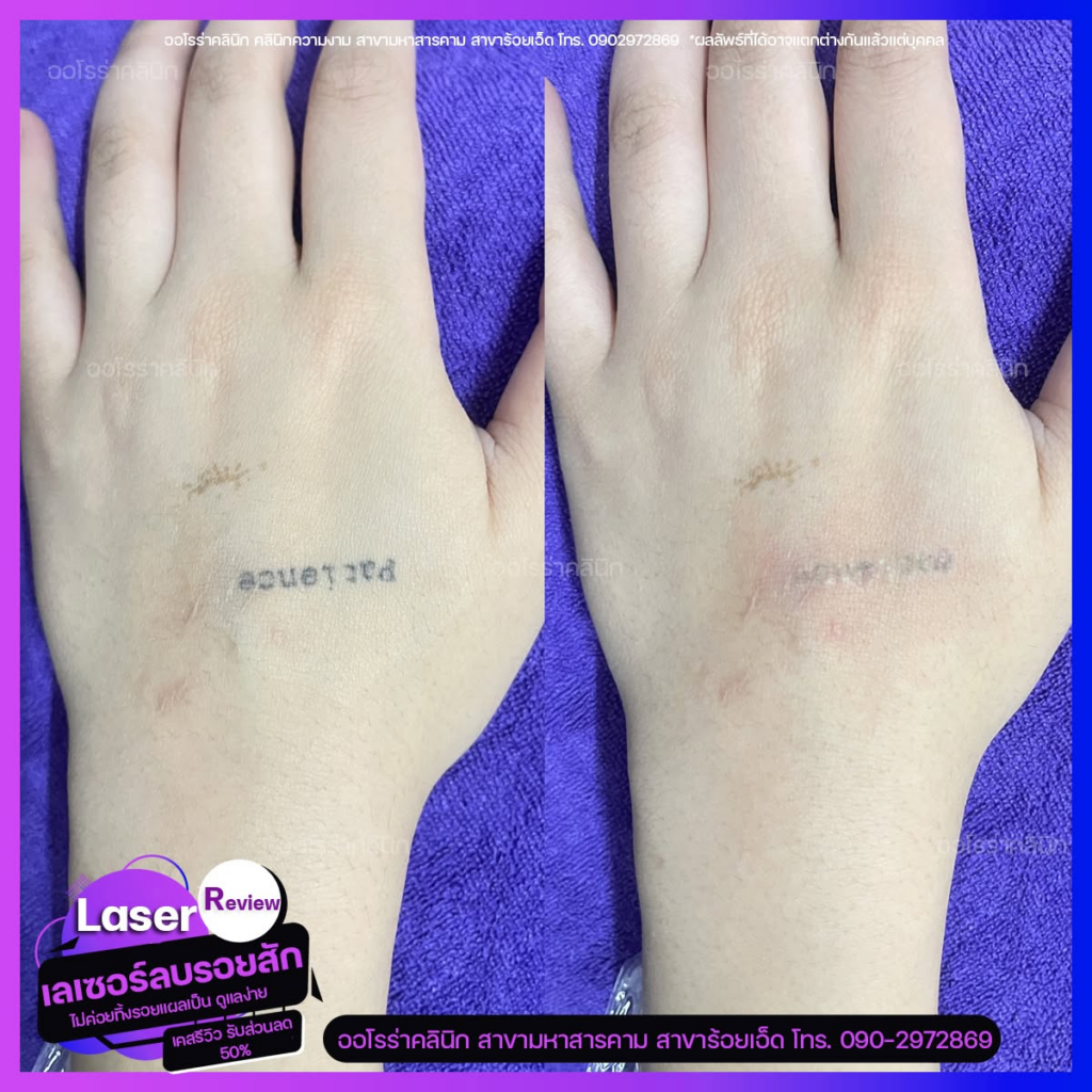 รีวิวคลินิกเสริมความงาม ร้อยเอ็ด ที่ AURORA CLINIC